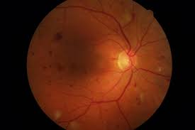How Diabetic Retinopathy looks in your eye