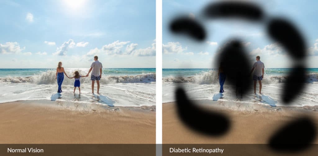 A visual effect of what advanced diabetic retinopathy looks like