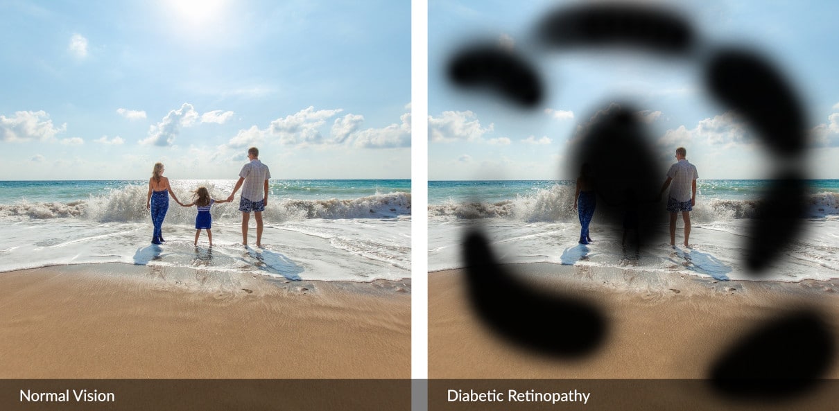 A visual effect of what advanced diabetic retinopathy looks like