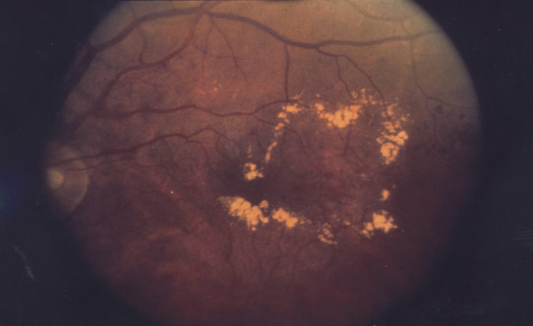 Diabetic macular edema, with hard exudates surrounding the blood vessels.