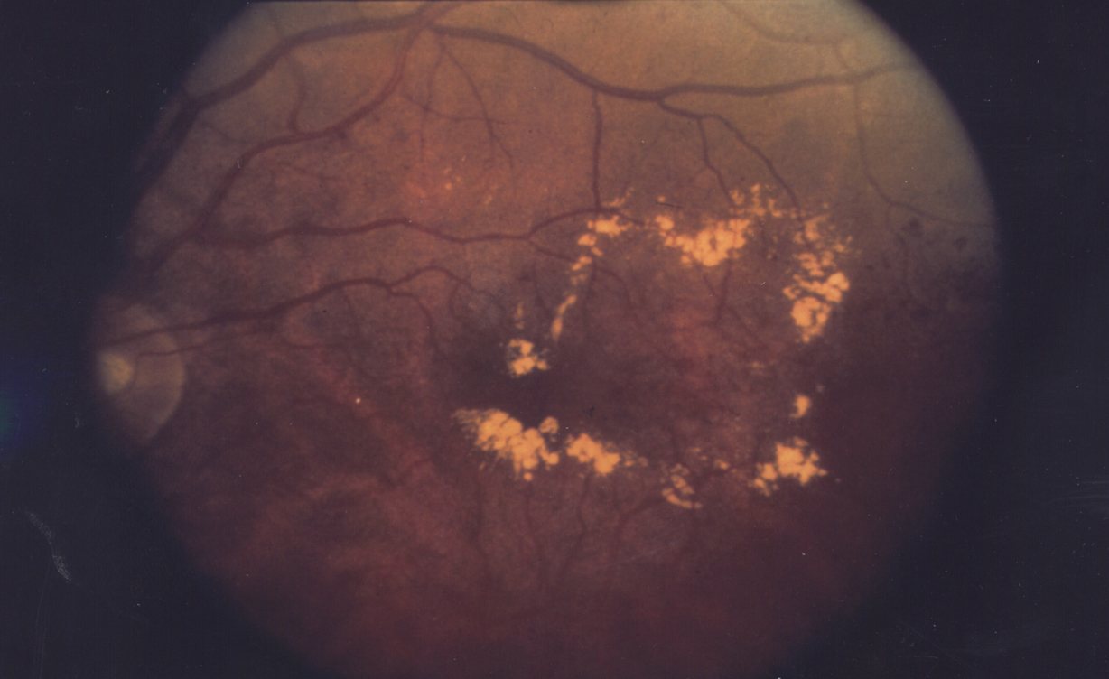 Diabetic macular edema, with hard exudates surrounding the blood vessels.