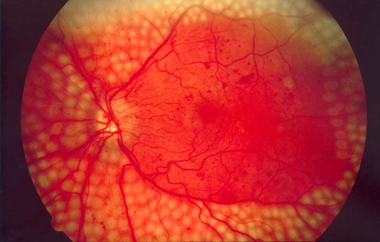 Fundus photo showing scatter laser surgery for diabetic retinopathy