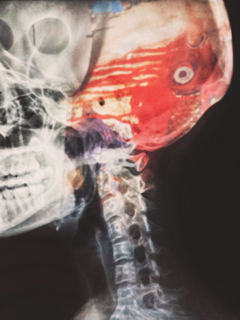Insulin resistance can worsen inflammation and cognitive decline